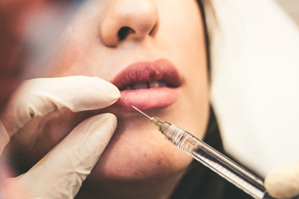 Dermalni fileri za povećanje volumena usana
