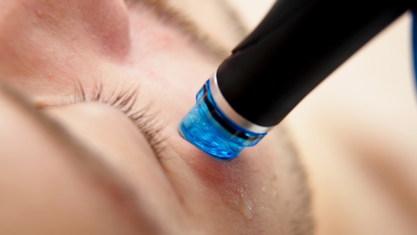 Microneedling – obraz